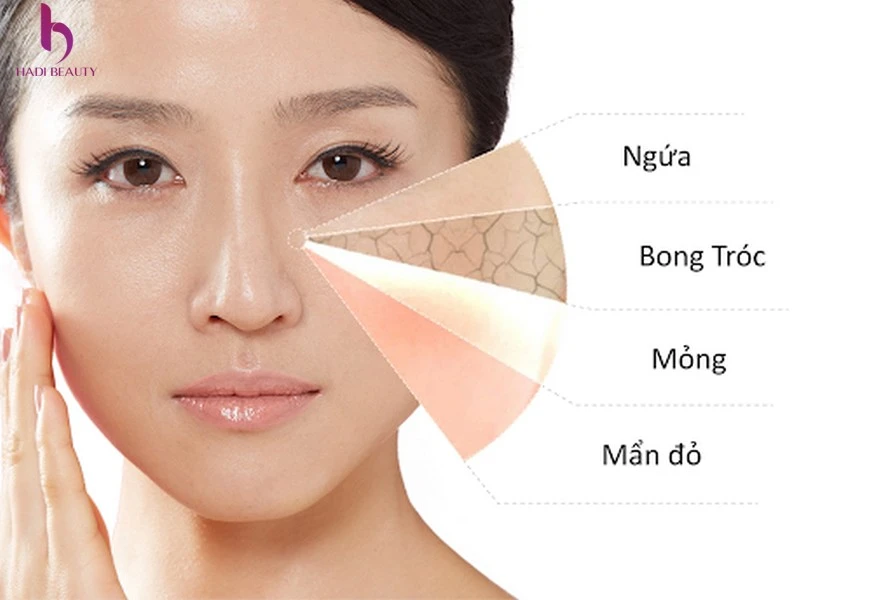 Da nhạy cảm vì sao cần dùng kem dưỡng ẩm