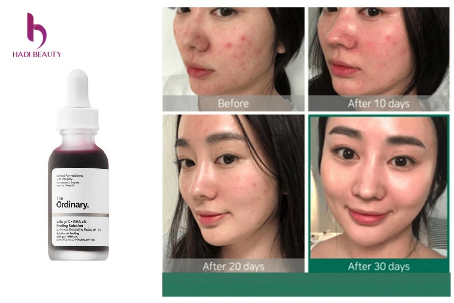 axit salicylic