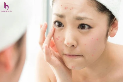 Nguyên nhân gây ra mụn do bít tắc lỗ chân lông